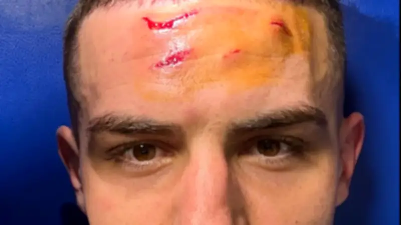 Atalanta-Held zeigt blutiges Gesicht: Dieses Foto schmerzt nur den BVB!