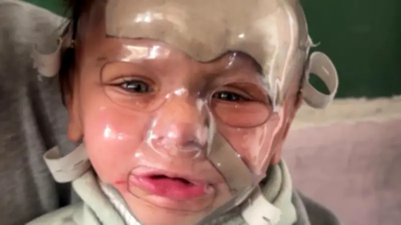 Gazastreifen: Einjähriger Mohammed überlebt nur mit Spezialmaske von Ärzte ohne Grenzen