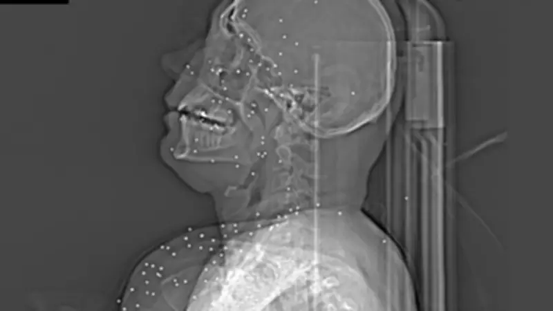 Iran-Proteste: Regime schießt mit Schrotkugeln auf Zivilisten - Röntgenbilder belegen Brutalität