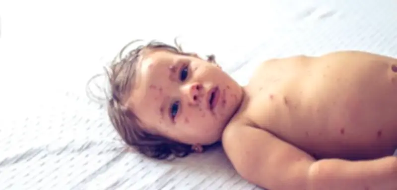 Masernfälle in Europa stark gesunken, doch Nordamerika bereitet WHO vor WM Sorgen