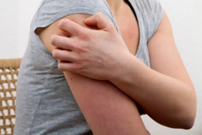 Nesselsucht: Ursachen, Symptome und Behandlungsmöglichkeiten der Hauterkrankung