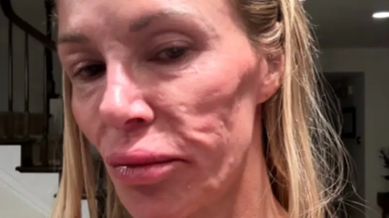 Real-Housewives-Star: Geplatzte Brustimplantate statt Parasiten verursachten Gesichtsdeformationen