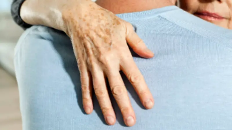 Altersflecken effektiv vorbeugen und behandeln: Dermatologische Methoden im Überblick