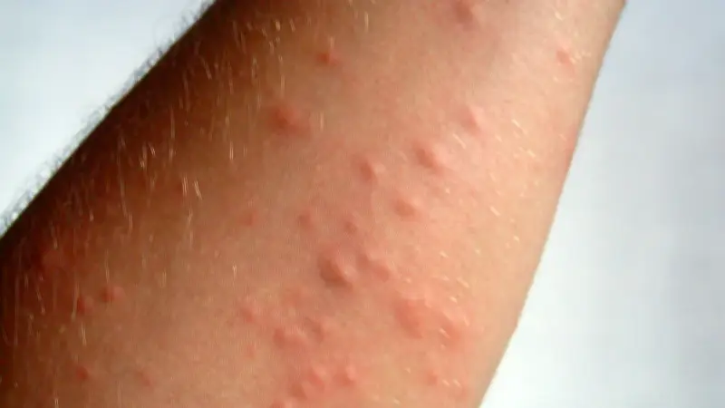 Follikulitis: Ursachen, Symptome und Behandlung der Haarbalgentzündung