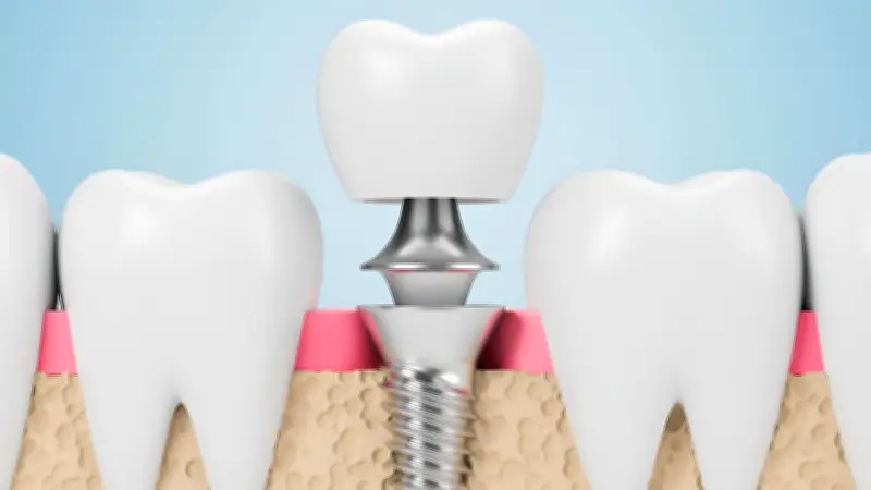 Moderne Implantologie in Springe: Nachhaltiger Zahnersatz für optimale Gesundheit
