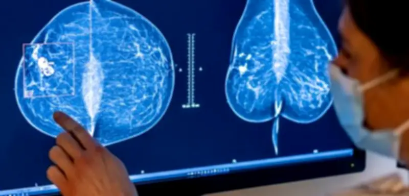 Studie enthüllt: Sechs vermeidbare Risikofaktoren für Brustkrebs-Todesfälle identifiziert