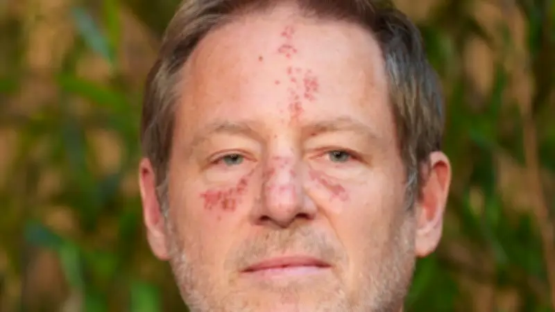 Oscar-Preisträger Florian Gallenberger zeigt rote Flecken im Gesicht