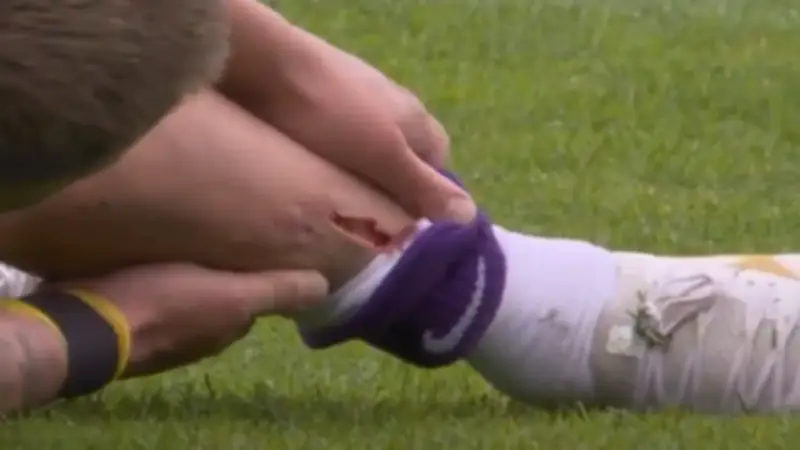 Schockierende Verletzung bei Lewis Holtby: Bösartige Fleischwunde am Schienbein