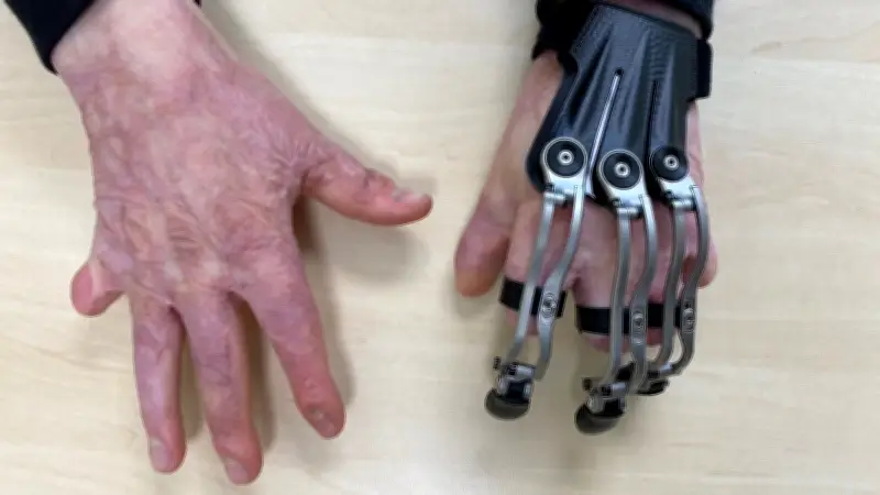 Schwerer Unfall in Sachsen: Moderne Prothetik aus Halle ermöglicht Rückkehr ins Leben