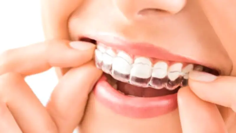 Kieferorthopädische Frühbehandlung: Wann ist der richtige Zeitpunkt?