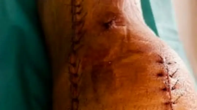 Schock-Video: St. Pauli-Star zeigt monströse Knie-Narbe nach Kreuzbandriss
