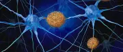 Alzheimer-Medikament Donanemab zeigt auch nach Absetzen Wirkung