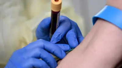 Jung, fit, aber hohe Cholesterinwerte: Warum Sie trotzdem zur Risikogruppe zählen können